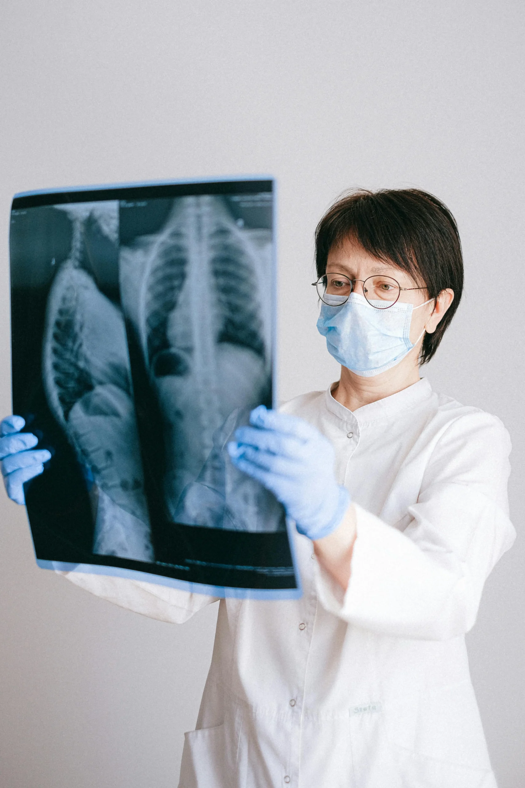 Medical professional examining a chest X-ray, representing diagnosis and legal evidence in mesothelioma lawsuit cases.